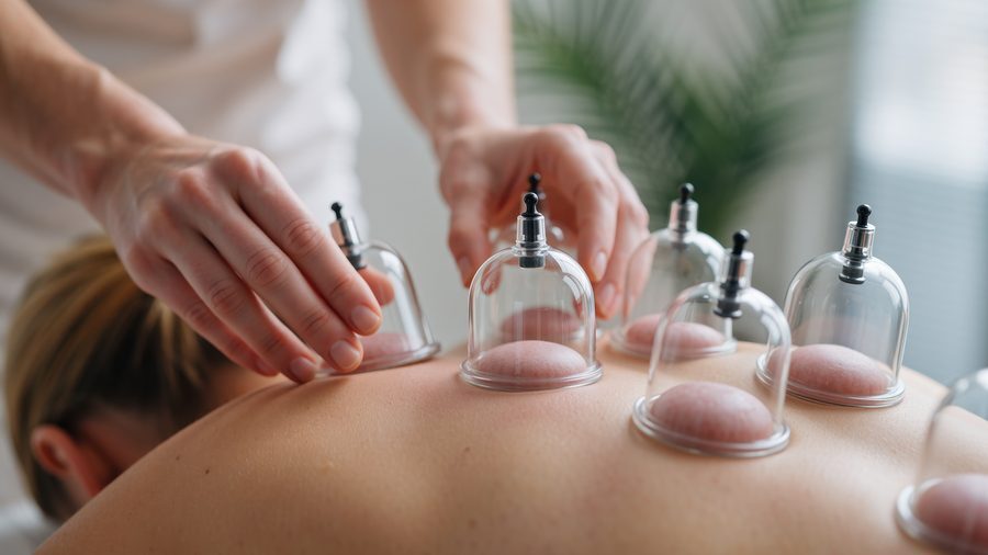Therapist applying cupping therapy to a patient's back