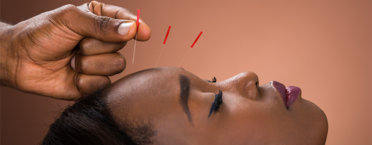 What is Dry Needling?  Preferred Physical Therapy
